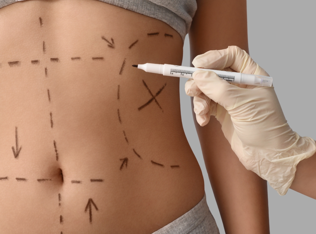 Foto de Qual é a Cirurgia Plástica Mais Feita no Mundo? Descubra Aqui