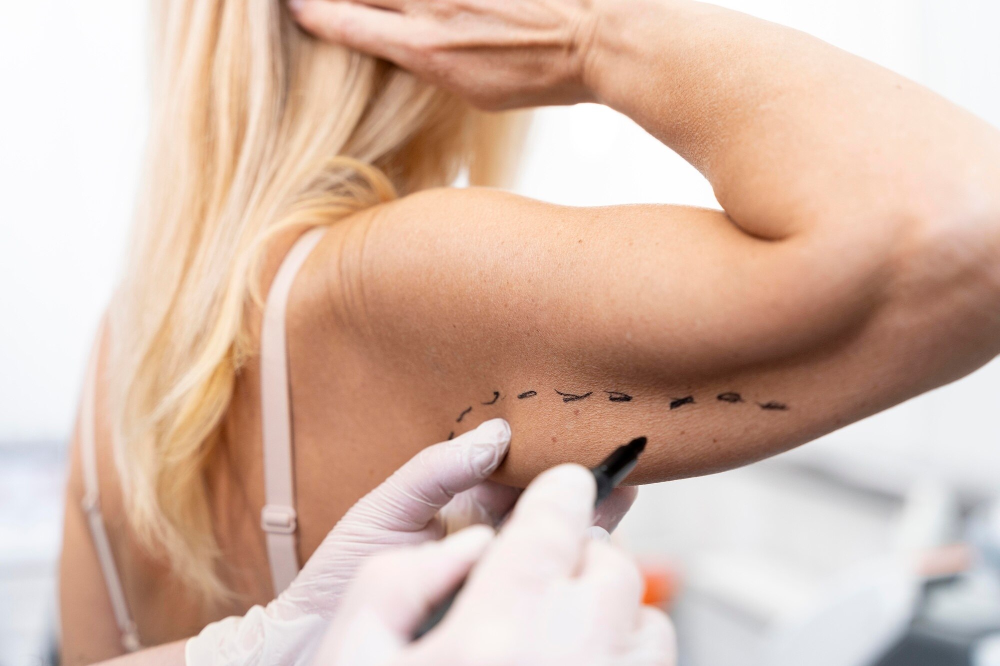 Imagem do procedimento Braquioplastia