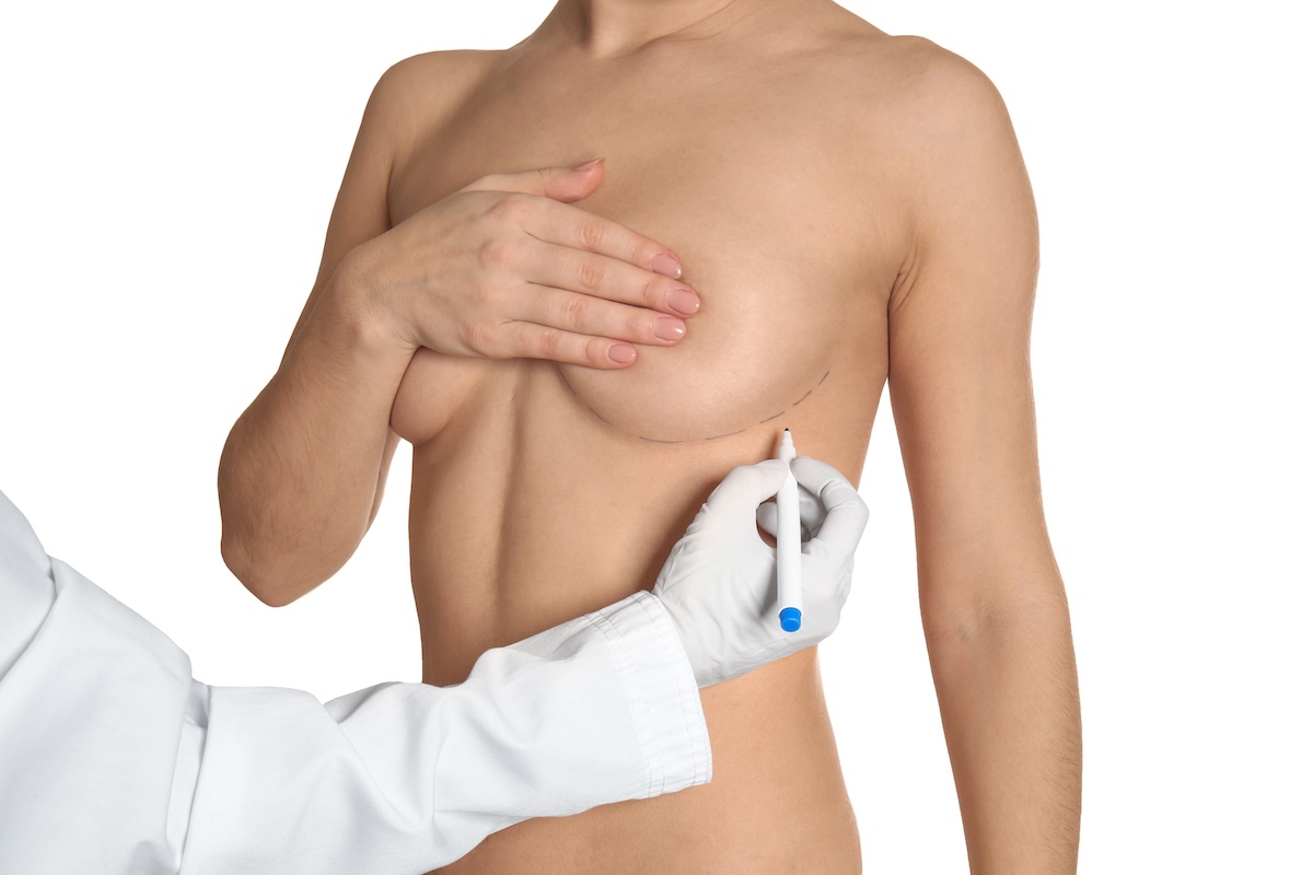 Imagem do procedimento Mamoplastia de Aumento