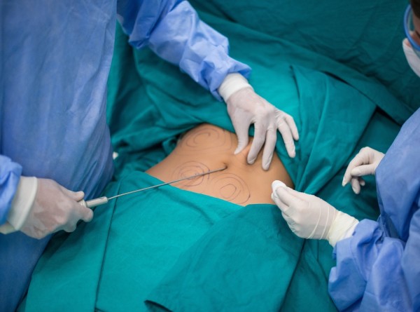 Imagem do post Lipoaspiração Mais Quantum: O Que Essa Combinação Faz Que a Lipo Sozinha Não Consegue
