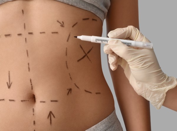 Imagem do post Qual é a Cirurgia Plástica Mais Feita no Mundo? Descubra Aqui